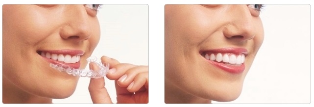 Removable Clear Aligner