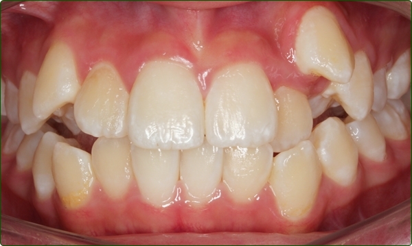 牙齒矯正專科-箍牙醫生-箍牙常見問題-牙齒矯正問題-牙齒排列不齊