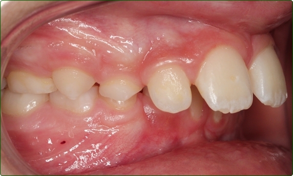 牙齒矯正專科-箍牙醫生-箍牙常見問題-牙齒矯正問題-哨牙-牙齒排列不齊